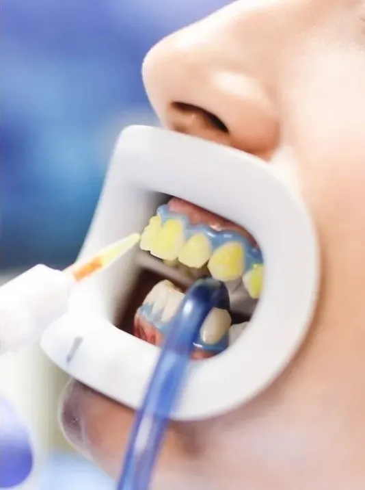 Your Trusted Teeth Whitening Clinic in Danforth