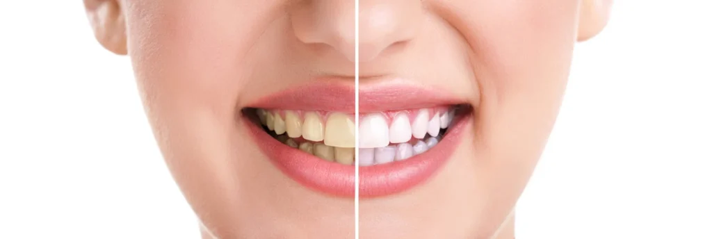 Our Teeth Whitening Services