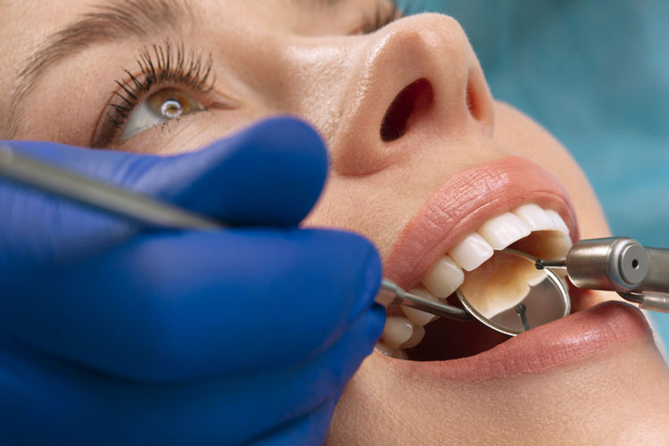 Close up of best tooth filling types in a dental procedure