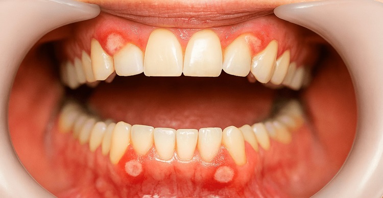 pictures of dental sores 