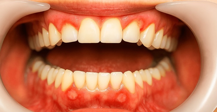 ulcers dental