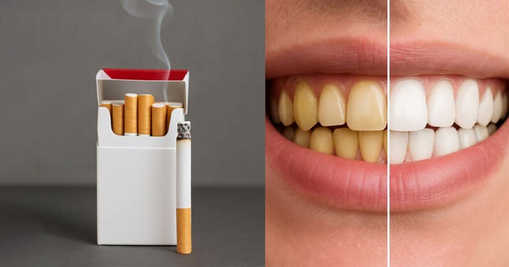 Teeth whitening for smokers