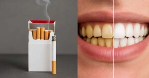Teeth whitening for smokers