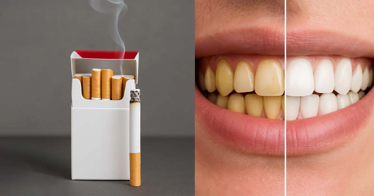 Teeth whitening for smokers