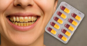 remove amoxicillin stains from teeth