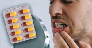 remove amoxicillin stains from teeth