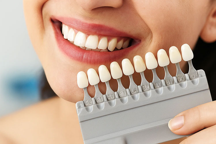 dental veneers vs laminates close view of teeth