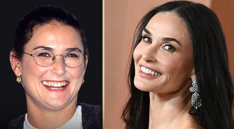 Demi Moore smile before and after