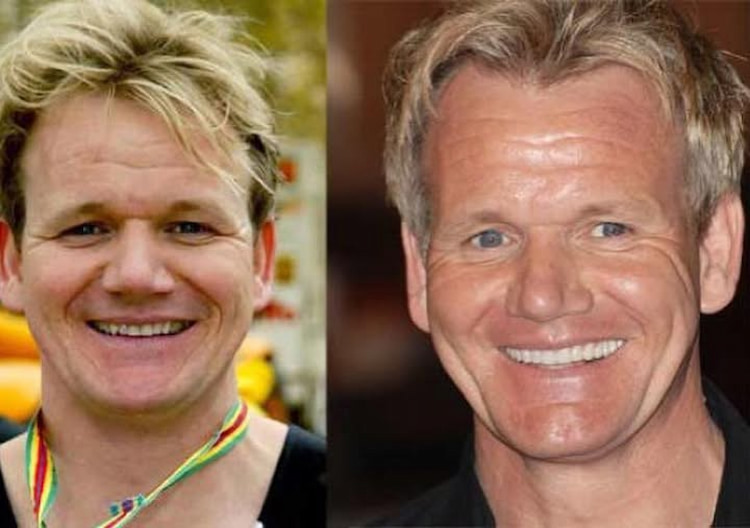 Gordon Ramsay's smile before & after