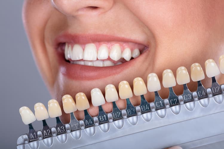 different color and shades of veneers near a patient's teeth.