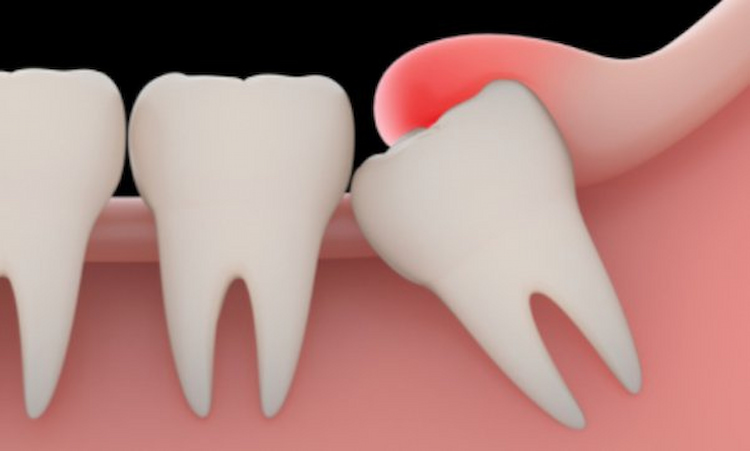 a wisdom tooth growing in an incorrect direction, causing gum flaps. 