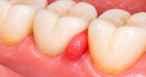 close-up of gum flaps between two teeth.