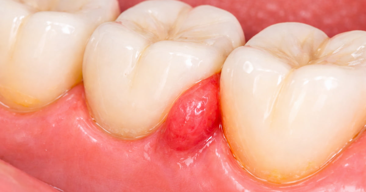 close-up of gum flaps between two teeth.