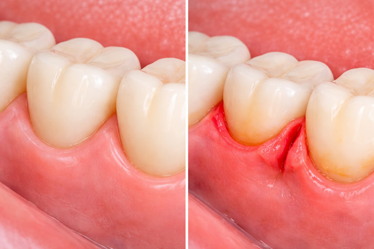 a split image showing healthy gums on the left and gum flaps between teeth on the right. 