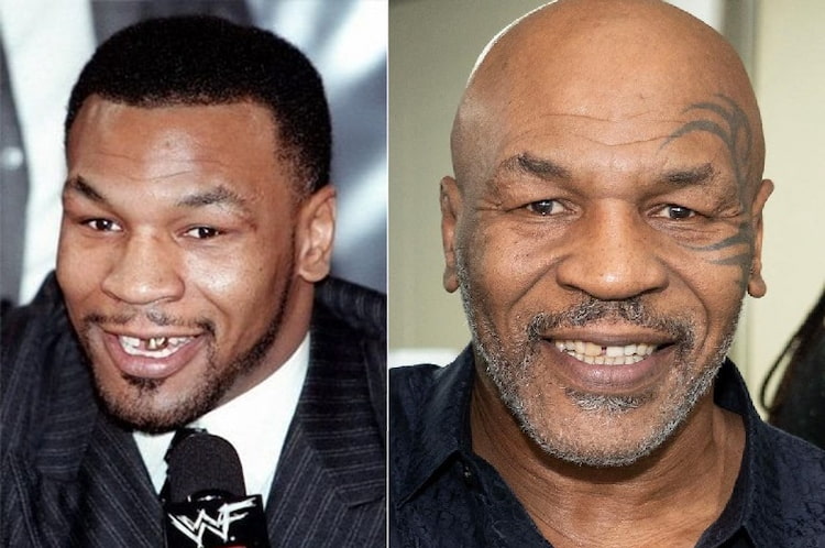 Mike Tyson's smile transformation with dental implants