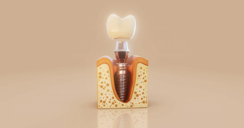 a structure of scewless dental implants