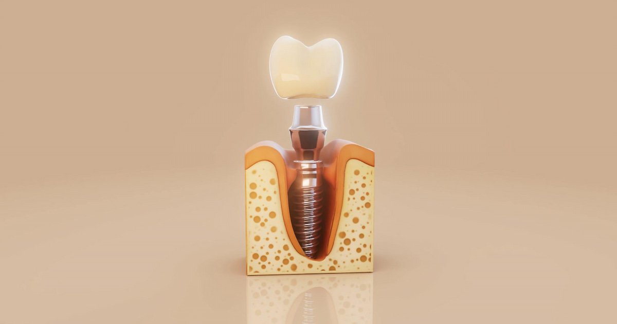 a structure of scewless dental implants