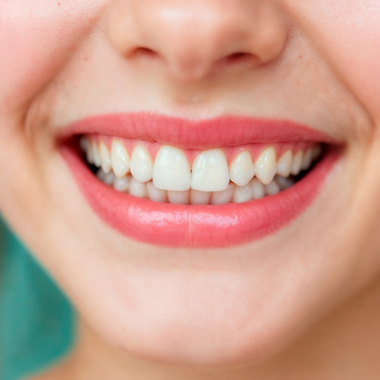 a woman is smiling with her dental veneers.