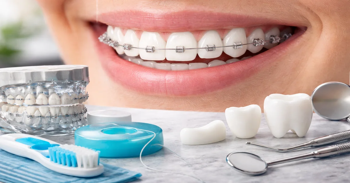 A picture representing braces with crowns or veneers