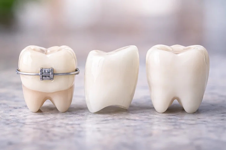 A picture of 3 different types of tooth