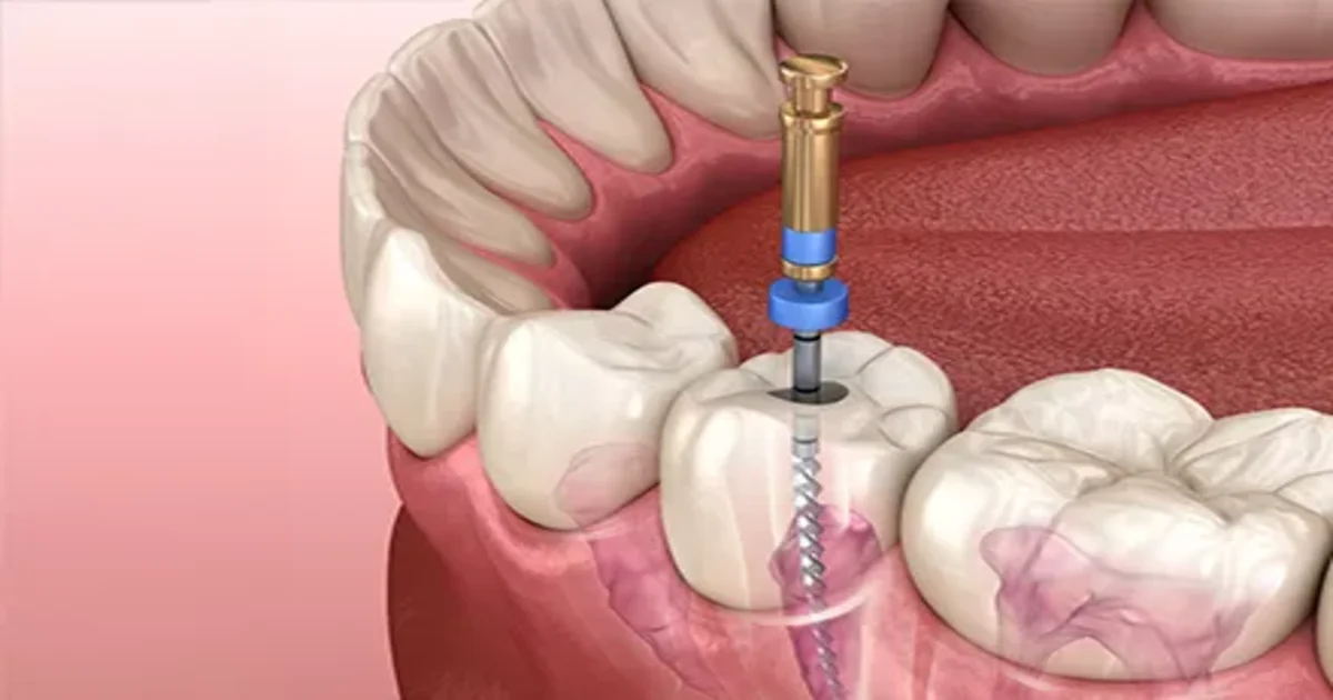 A picture representing root canal treatment