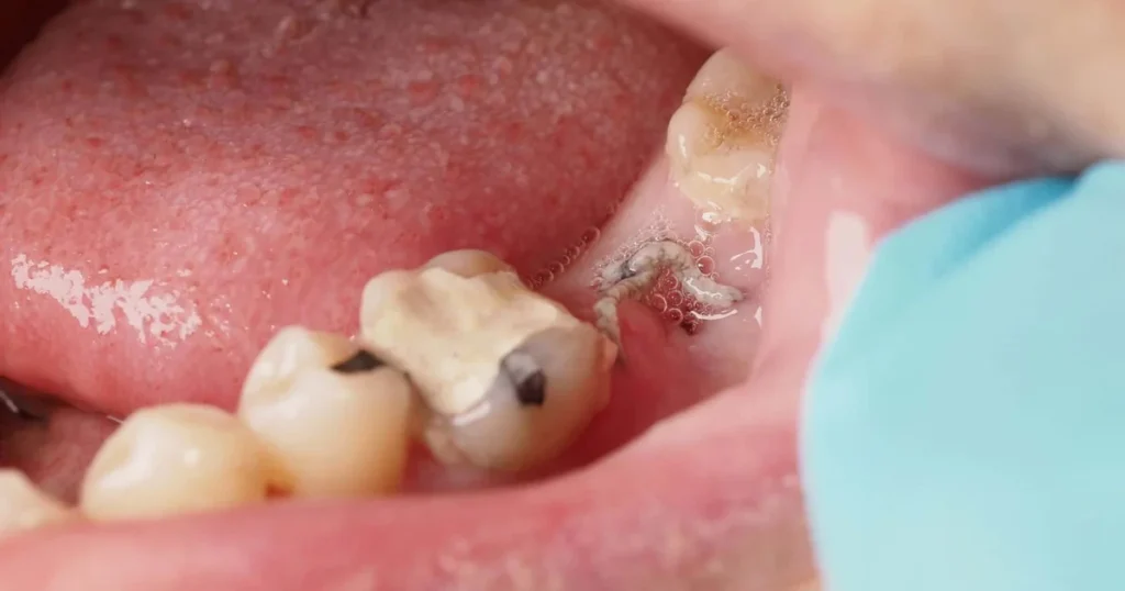 A picture of a infected wisdom tooth