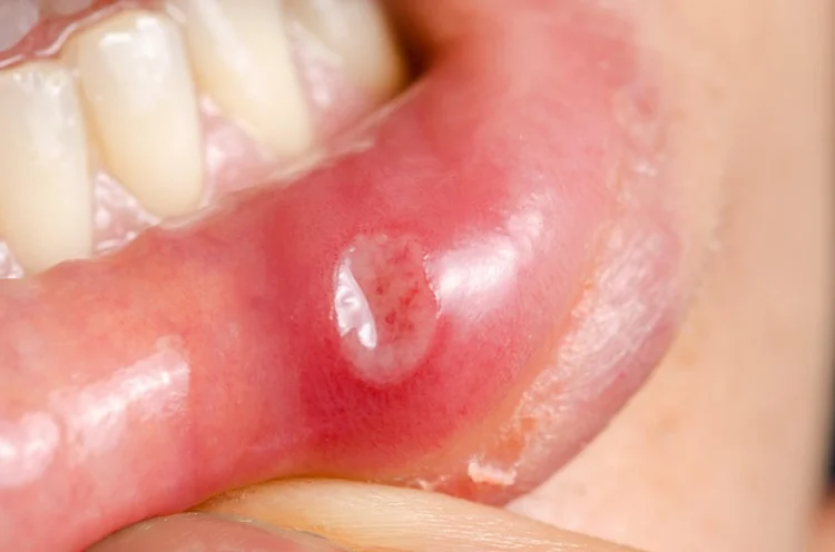 A picture of a person with sore mouth representing infection after dental work