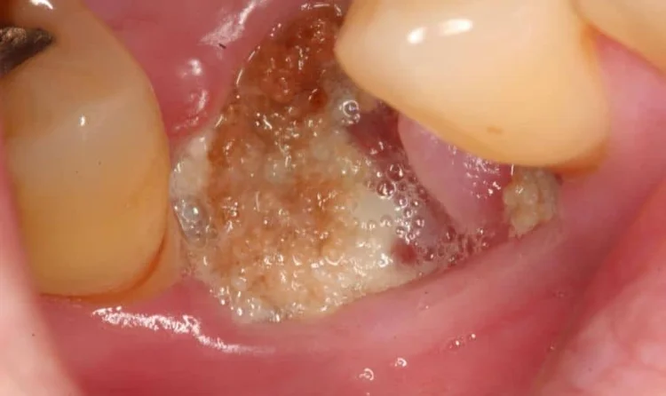 An image demonstarting infection after dental work