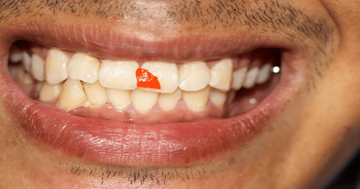 A picture of the food stuck in gums