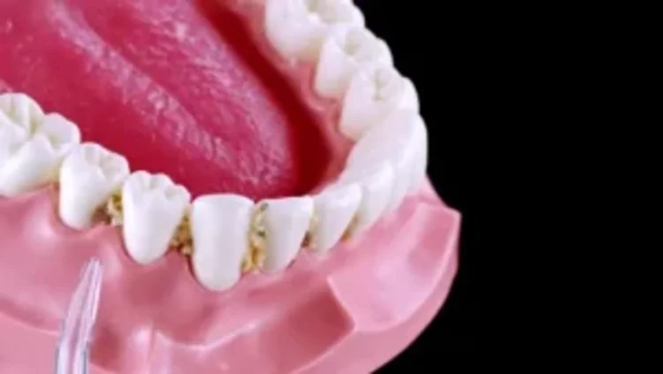 a picture of food stuck in gums