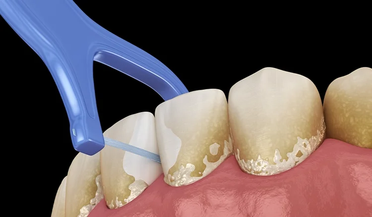 A picture representing toothpick and food stuck in gums