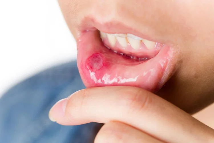 An image representing sore mouth after oral surgery