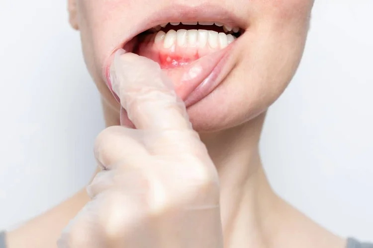 A picture of a woman holding her lower lip trying to show sore mouth after oral surgery