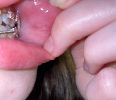 mouth sores from braces pictures