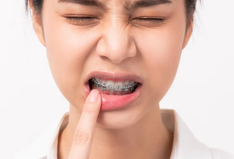 A picture of a girl with braces who issuffering from mouth sores