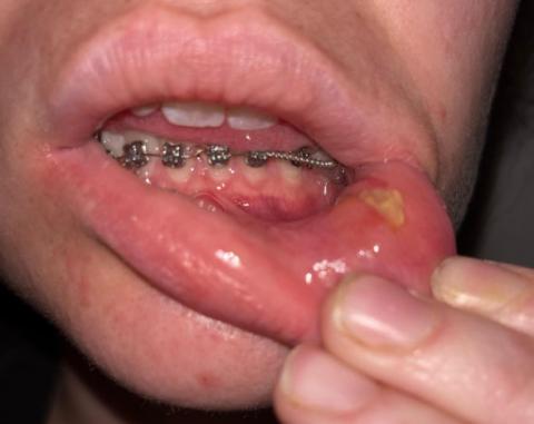 mouth sores from braces pictures