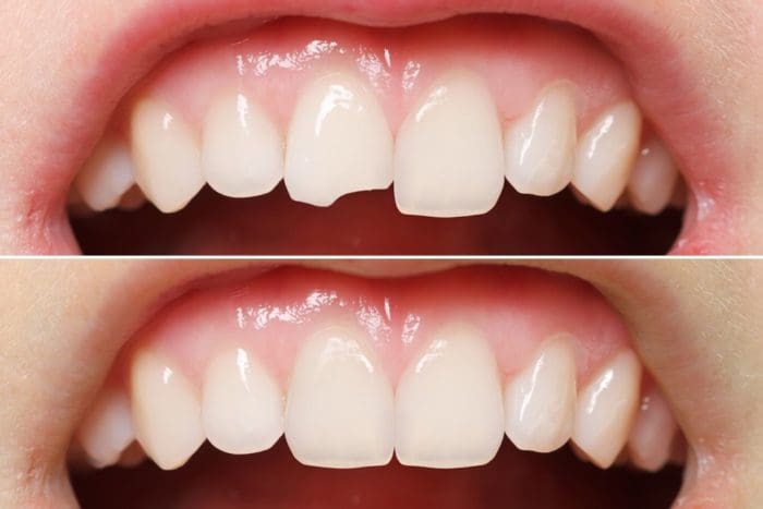 top cosmetic dentistry options for crooked teeth: dental bonding