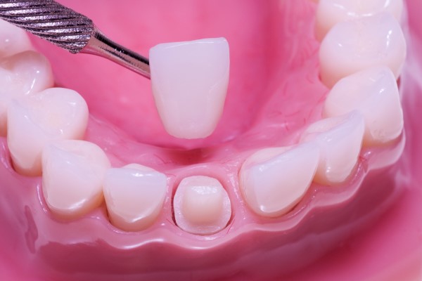 cosmetic dentistry options for crooked teeth: dental crowns