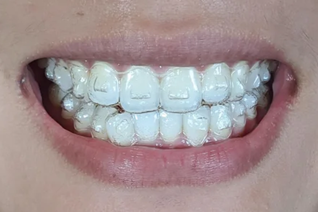 cosmetic dentistry options for crooked teeth: Invisalign