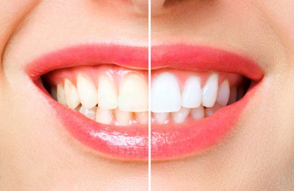 how long does teeth whitening last