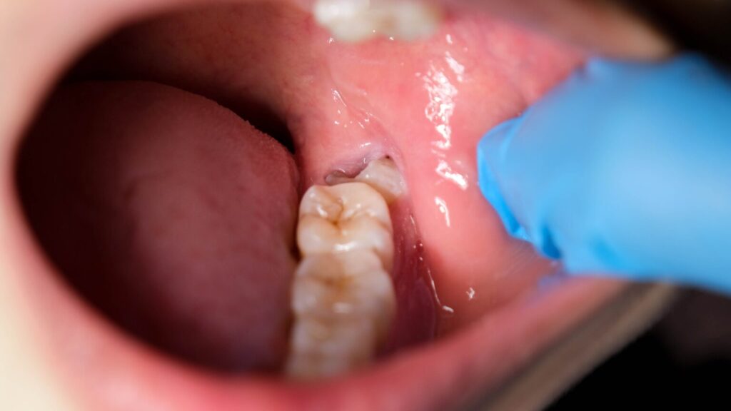 Does CDCP cover wisdom teeth removal