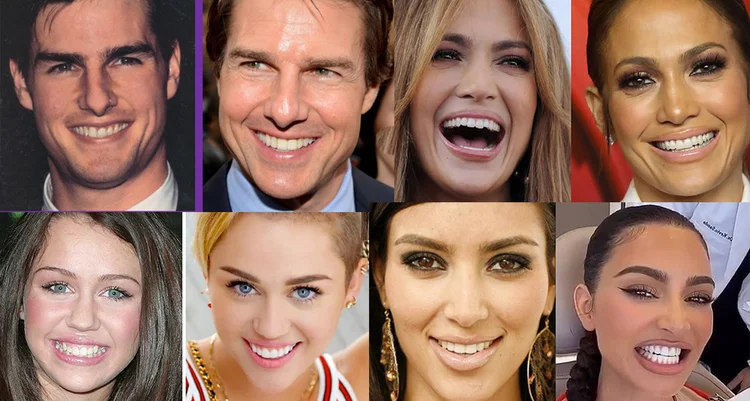A picture of 4 celebrities with veneers