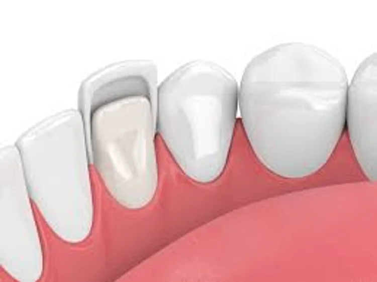 A picture demonstarting dental veneers