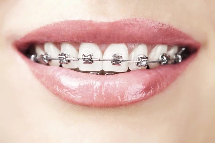 A picture of braces