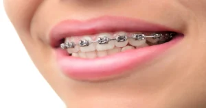 braces cost in canada
