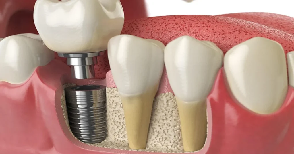 A picture of a dental implant