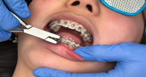 A picture of a patient getting braces