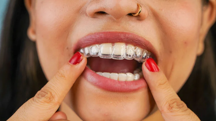 A picture taken from a woman with clear aligners