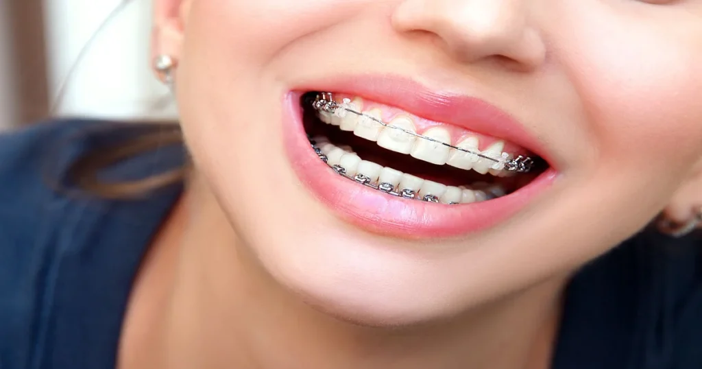 a picture of a woman with braces
