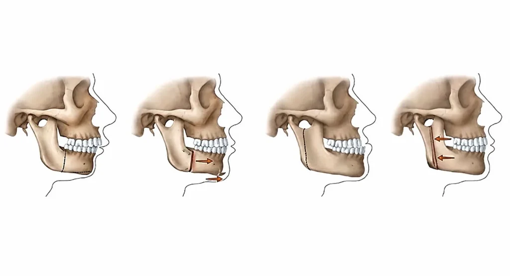 Snoring and sleep apnea are not treated the same way for everyone